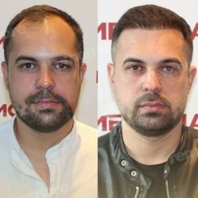 Before and after FUE hair transplant results at Memorial Antalya Hospital for male patient