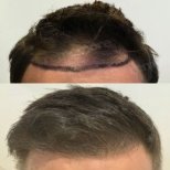 FUE hair transplant before and after results at Memorial Antalya Hospital, restored hairline