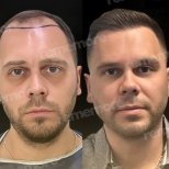 Before and after FUE hair transplant results at Memorial Antalya Hospital, restored hairline