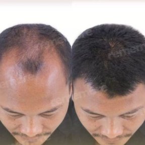 Before and after FUE hair transplant results at Memorial Antalya Hospital, restored hairline