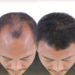 Before and after FUE hair transplant results at Memorial Antalya Hospital, restored hairline
