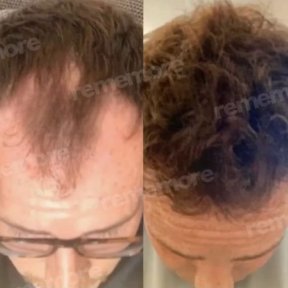 Before and after FUE hair transplant results at Memorial Antalya Hospital, restored hairline