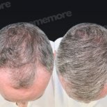 Before and after FUE hair transplant results at Memorial Antalya Hospital, improved hair density