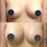 Before and after breast implants with lift results at Memorial Bahçelievler Hospital
