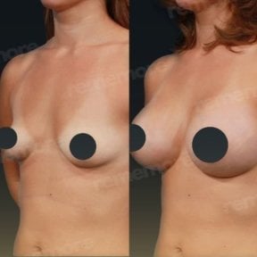 Before and after breast implants with lift results at Memorial Bahçelievler Hospital