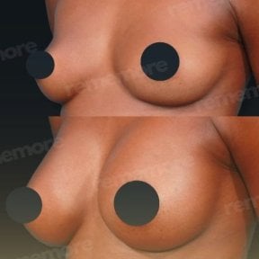 Before and after breast implants with lift results at Memorial Bahçelievler Hospital