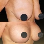 Before and after breast implants with lift results at Memorial Bahçelievler Hospital