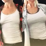 Before and after breast implants with lift results at Memorial Bahçelievler Hospital
