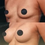 Before and after breast implants with lift results at Memorial Bahçelievler Hospital