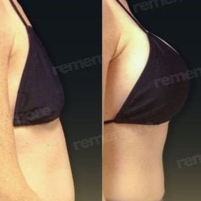 Before and after breast implants with lift at Memorial Bahçelievler Hospital, enhanced contour result