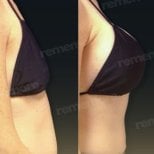Before and after breast implants with lift at Memorial Bahçelievler Hospital, enhanced contour result