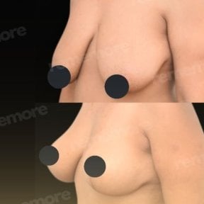 Before and after breast implants with lift results at Memorial Bahçelievler Hospital