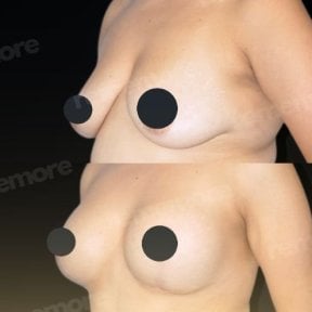 Before and after breast implants with lift results at Memorial Bahçelievler Hospital