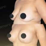 Before and after breast implants with lift results at Memorial Bahçelievler Hospital