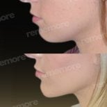 Before and after chin liposuction results at Memorial Bahçelievler Hospital, improved jawline