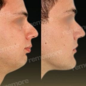 Before and after chin liposuction results at Memorial Bahçelievler Hospital, improved jawline