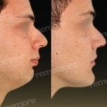 Before and after chin liposuction results at Memorial Bahçelievler Hospital, improved jawline