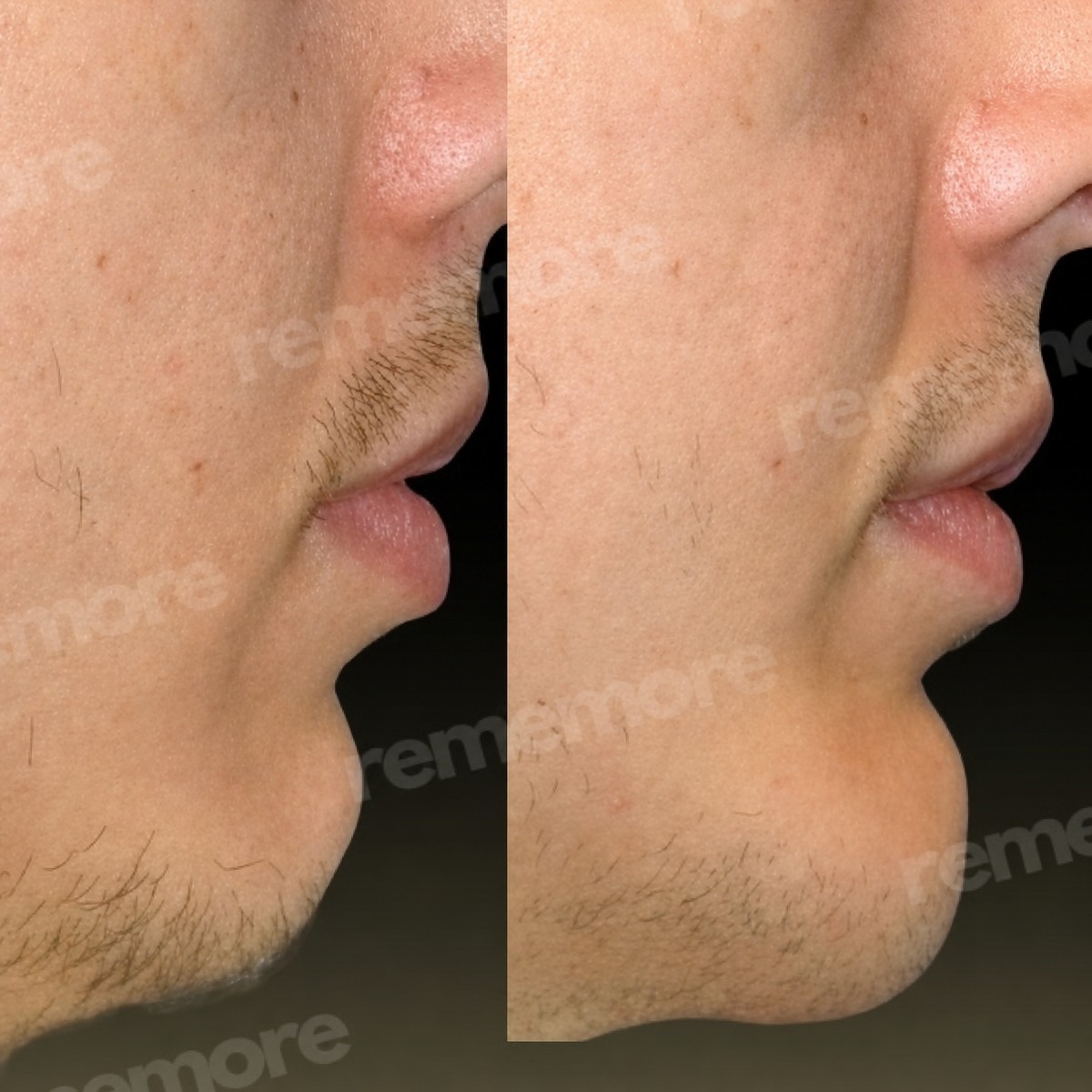 Resultados de liposucción de mentón antes y después en Memorial Bahçelievler Hospital, línea mandibular mejorada