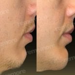 Before and after chin liposuction results at Memorial Bahçelievler Hospital, improved jawline