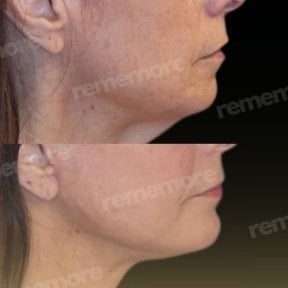 Before and after chin liposuction results at Memorial Bahçelievler Hospital, improved jawline