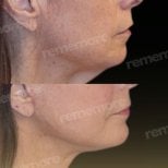 Before and after chin liposuction results at Memorial Bahçelievler Hospital, improved jawline