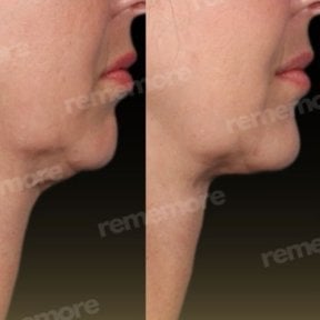 Before and after chin liposuction results at Memorial Bahçelievler Hospital, improved jawline