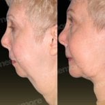 Before and after chin liposuction results at Memorial Bahçelievler Hospital, improved jawline