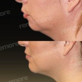 Before and after chin liposuction results at Memorial Bahçelievler Hospital, improved jawline