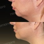 Before and after chin liposuction results at Memorial Bahçelievler Hospital, improved jawline