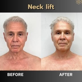 Before and after neck lift results at ID Clinic Bangkok, visible neck tightening and rejuvenation