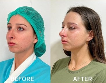 Before and after revision rhinoplasty result at ID Clinic Bangkok, improved nose shape