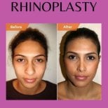 Before and after revision rhinoplasty results at ID Clinic Bangkok, improved nose shape