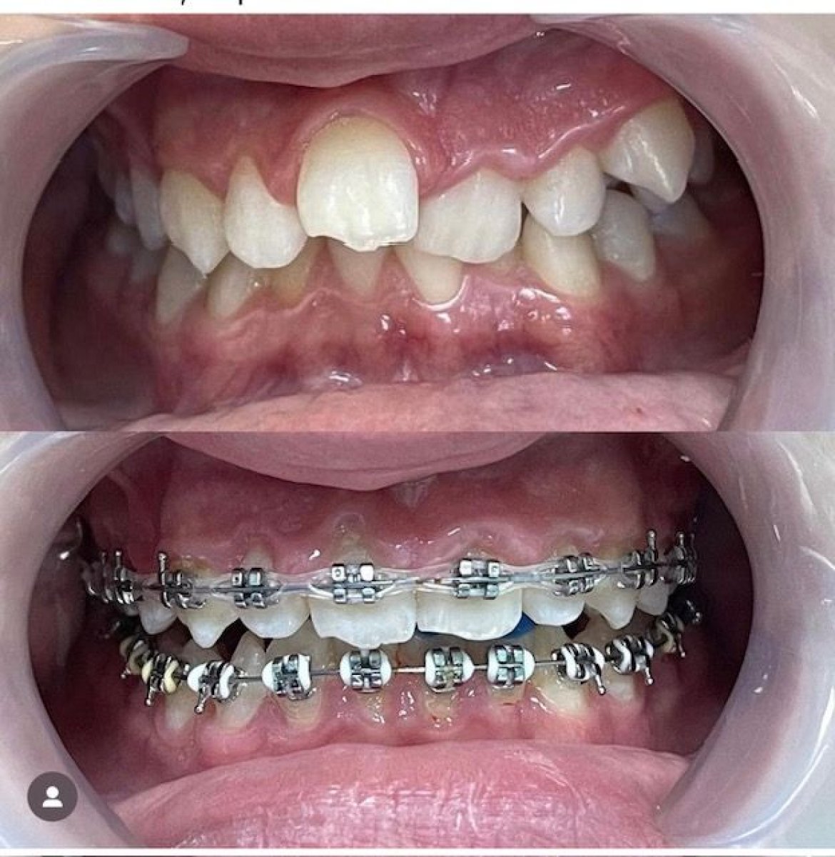 نتائج تقويم الأسنان للكبار في عيادة VerMax Dental Clinic، تحسين اصطفاف الأسنان