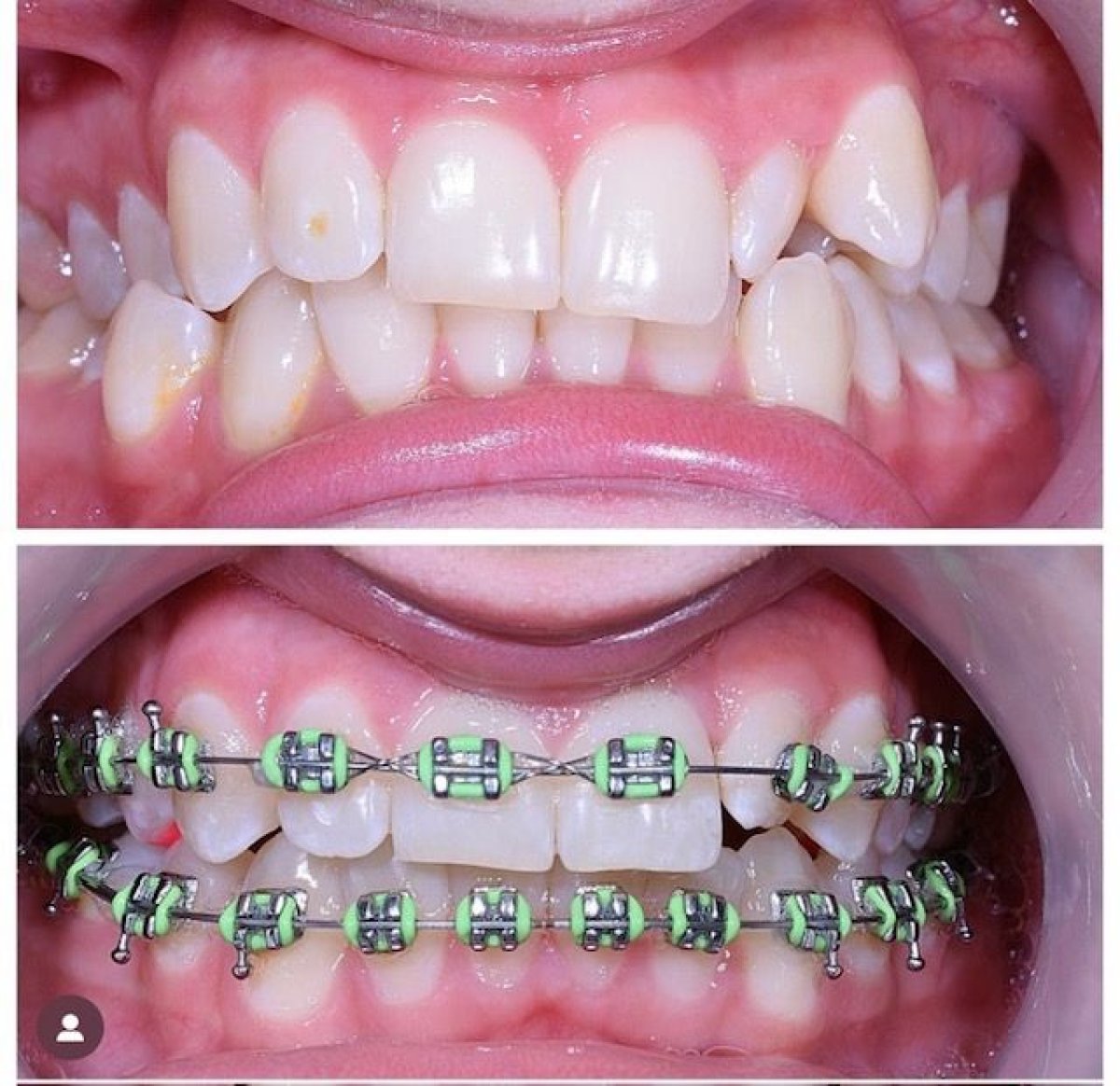 نتائج قبل وبعد تقويم الأسنان للكبار في عيادة VerMax Dental Clinic، تقويم الأسنان واضح