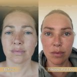 Before and after brow lift results at Dr. Safa Manav Clinic, visible eyebrow lift improvement