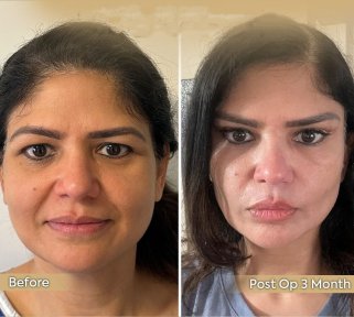 Brow lift before and after results at Dr. Safa Manav Clinic, visible eyebrow lift improvement