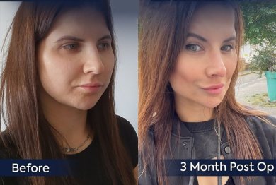 Brow lift before and after results at Dr. Safa Manav Clinic, visible forehead lift improvement
