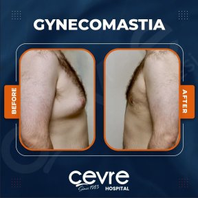 Vorher-nachher-Ergebnis der Gynäkomastie-OP im Cevre Hospital, männliche Brustkorrektur