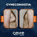 Vorher-nachher-Ergebnis der Gynäkomastie-OP im Cevre Hospital, männliche Brustkorrektur