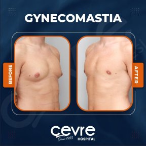 Vorher-nachher-Ergebnis Gynäkomastie-OP bei Adem and Havva Medical Center, Brustkontur