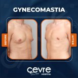 Vorher-nachher-Ergebnis Gynäkomastie-OP bei Adem and Havva Medical Center, Brustkontur