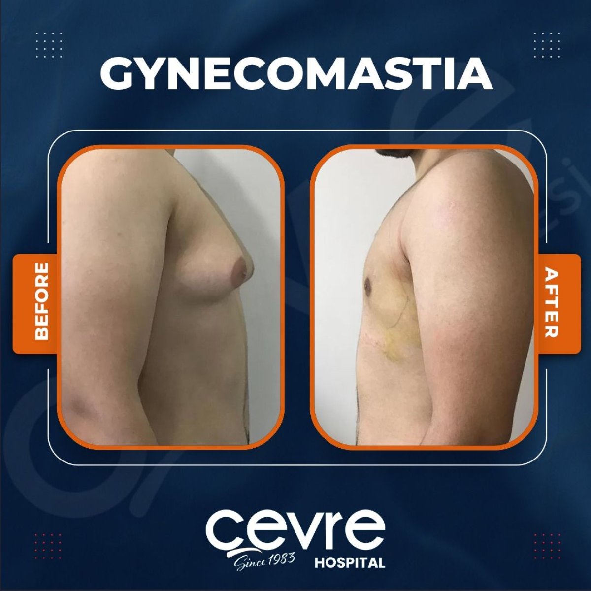 Resultados antes y después de ginecomastia en Adem and Havva Medical Center, contorno de pecho