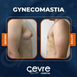 Vorher-nachher-Ergebnis Gynäkomastie-OP bei Adem and Havva Medical Center, Brustkontur