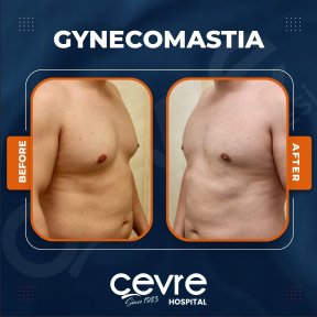 Vorher-nachher-Ergebnis Gynäkomastie-OP bei Adem and Havva Medical Center, Brustkontur