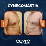 Vorher-nachher-Ergebnis Gynäkomastie-OP bei Adem and Havva Medical Center, Brustkontur