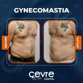 Vorher-nachher-Ergebnis Gynäkomastie-OP bei Adem and Havva Medical Center, Brustkontur