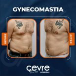 Vorher-nachher-Ergebnis Gynäkomastie-OP bei Adem and Havva Medical Center, Brustkontur