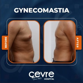 Vorher-nachher-Ergebnisse der Gynäkomastie-OP bei Adem and Havva Medical Center, Brustform