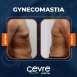 Vorher-nachher-Ergebnisse der Gynäkomastie-OP bei Adem and Havva Medical Center, Brustform