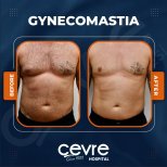 Vorher-nachher-Ergebnis Gynäkomastie-OP bei Adem and Havva Medical Center, Brustkontur